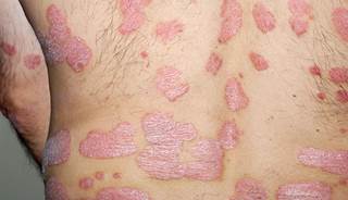 Obesity may precede pediatric psoriasis onset Obesity may precede pediatric psoriasis onset