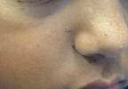 Factors Predictive of Everolimus Efficacy in Tuberous Sclerosis Complex Factors Predictive of Everolimus Efficacy in Tuberous Sclerosis Complex