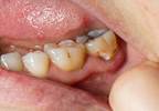 Dental caries may protect against certain cancers Dental caries may protect against certain cancers