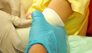 AAP: Evaluate child fractures for physical abuse AAP: Evaluate child fractures for physical abuse