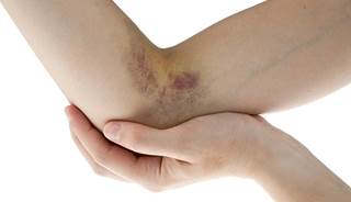 A patient's bruises prompt closer attention A patient's bruises prompt closer attention