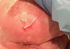 Obstructive Sleep Apnea Medication Leads to Skin Rash in Patient Obstructive Sleep Apnea Medication Leads to Skin Rash in Patient