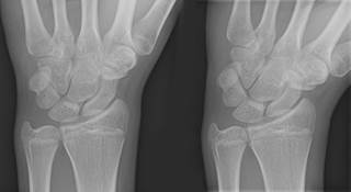 Median Neuropathy May Be Early Sign of Diabetic Neuropathy Median Neuropathy May Be Early Sign of Diabetic Neuropathy