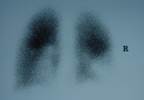 Prostate Cancer ADT Ups Thromboembolic Event Risk Prostate Cancer ADT Ups Thromboembolic Event Risk