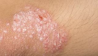 Secukinumab effective for plaque psoriasis Secukinumab effective for plaque psoriasis