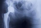 Do surgical metals affect security or MRI scans? Do surgical metals affect security or MRI scans?