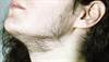 Treatment options for women with facial hair Treatment options for women with facial hair