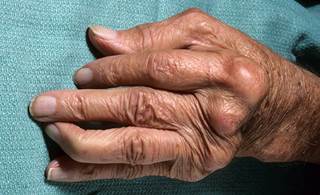 Weight loss is a strong predictor of mortality in patients with RA, Weight loss is a strong predictor of mortality in patients with RA,