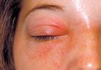 An infection
leads to blindness An infection
leads to blindness