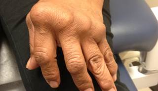 How effective is total knee replacement in patients with rheumatoid arthritis? How effective is total knee replacement in patients with rheumatoid arthritis?