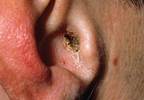 Treating antifungal-resistant ear infection
s Treating antifungal-resistant ear infection
s