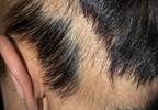 Topical immunotherapy for alopecia areata Topical immunotherapy for alopecia areata