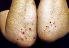 April 2014 Dermatology CME/CE April 2014 Dermatology CME/CE