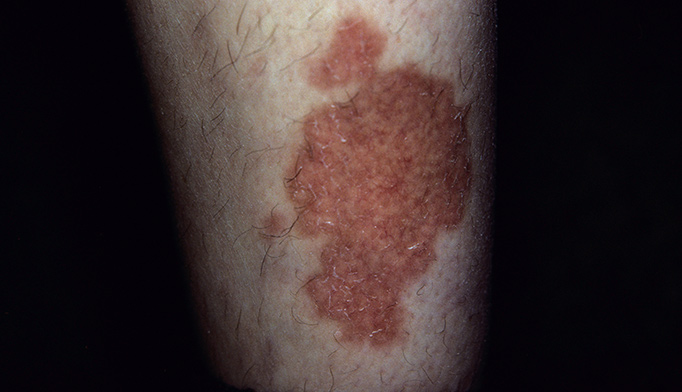 A spreading shin rash signifies systemic disease - The 