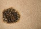 Blood test may improve advanced melanoma tracking Blood test may improve advanced melanoma tracking