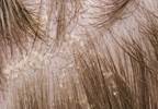 Steroids commonly prescribed for psoriasis Steroids commonly prescribed for psoriasis