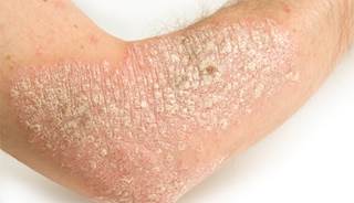 Psoriasis incidence greater than previously thought Psoriasis incidence greater than previously thought