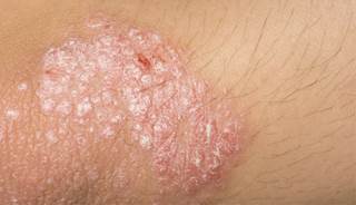 Psoriasis burden highlighted in new study Psoriasis burden highlighted in new study