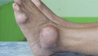 Psoriasis linked to increased gout risk Psoriasis linked to increased gout risk