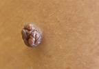 Melanoma risk elevated in patients with HIV/AIDS Melanoma risk elevated in patients with HIV/AIDS