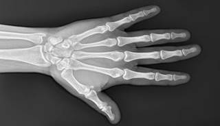 Numbness, tingling, weakness, and coolness in a "jammed" hand Numbness, tingling, weakness, and coolness in a "jammed" hand