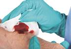 Numbing a wound on infected skin Numbing a wound on infected skin