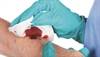 Numbing a wound on infected skin
Numbing a wound on infected skin