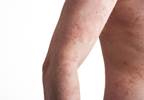 AP1S3 mutations associated with psoriasis AP1S3 mutations associated with psoriasis