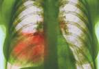Azithromycin pros beat cons in pneumonia Azithromycin pros beat cons in pneumonia