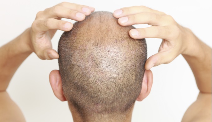 An easier path to punch biopsy of the scalp - The Clinical Advisor