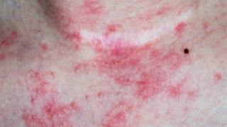 Dupilumab effective for atopic dermatitis - The Clinical Dupilumab effective for atopic dermatitis - The Clinical