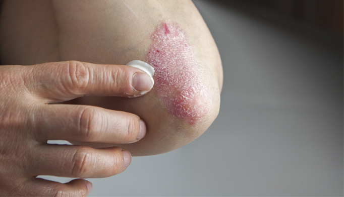 WHO recognizes psoriasis as chronic condition - The 