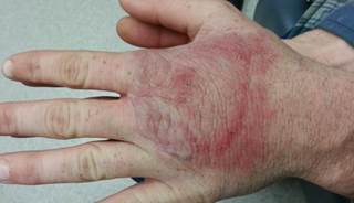 August 2014 Dermatology CME/CE August 2014 Dermatology CME/CE