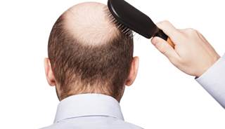 Cancer drug may restore hair in alopecia patients Cancer drug may restore hair in alopecia patients