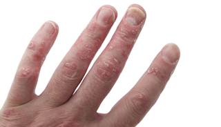 Antidrug antibodies impact adalimumab treatment outcomes in psoriatic arthritis Antidrug antibodies impact adalimumab treatment outcomes in psoriatic arthritis