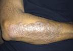 Psoriasis linked to increased chronic kidney disease, glomerulonephritis risk Psoriasis linked to increased chronic kidney disease, glomerulonephritis risk