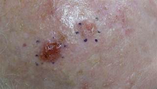 October 2014 Dermatologic Look-Alikes October 2014 Dermatologic Look-Alikes