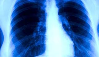 Lung cancer screening cost-effective for Medicare beneficiaries Lung cancer screening cost-effective for Medicare beneficiaries