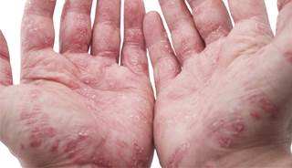 Phase 1 trial results favorable for experimental psoriasis drug Phase 1 trial results favorable for experimental psoriasis drug