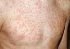 Don't overlook the resurgence of rubella Don't overlook the resurgence of rubella