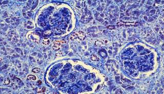 Glomerulonephritis (shown), a cause of AKI, may occur after a bacterial infection. Glomerulonephritis (shown), a cause of AKI, may occur after a bacterial infection.
