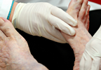 Inflamed foot in a patient with diabetes Inflamed foot in a patient with diabetes