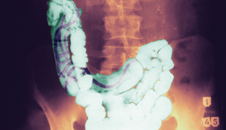 Abdominal cramping, foreign body in the stool of a child Abdominal cramping, foreign body in the stool of a child