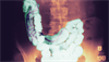 Abdominal cramping, foreign body in
the stool of a child Abdominal cramping, foreign body in
the stool of a child