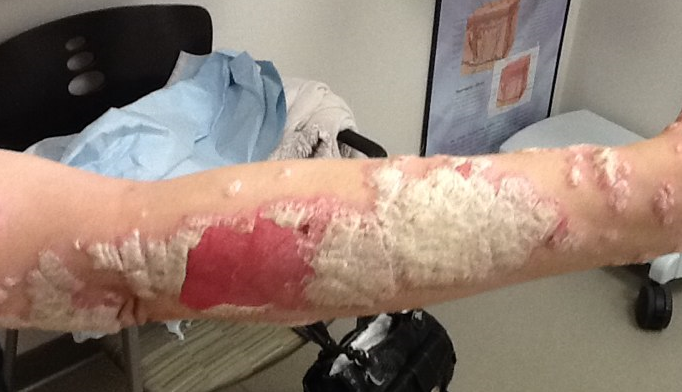 Psoriasis: When the 'usual suspect' therapy works - The Clinical Advisor