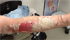 Psoriasis: When the 'usual suspect' therapy works Psoriasis: When the 'usual suspect' therapy works