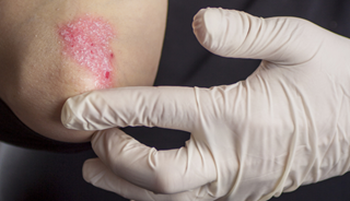 People with psoriasis suffer from a lot of stigma due to misconceptions. People with psoriasis suffer from a lot of stigma due to misconceptions.