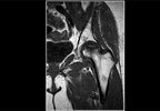 Risk Factor for Osteonecrosis in Patients With SLE Risk Factor for Osteonecrosis in Patients With SLE