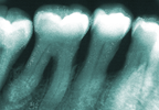 Preventing and treating periodontitis Preventing and treating periodontitis