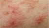 Multiple dermatologic rashes complicate psoriasis diagnosis Multiple dermatologic rashes complicate psoriasis diagnosis